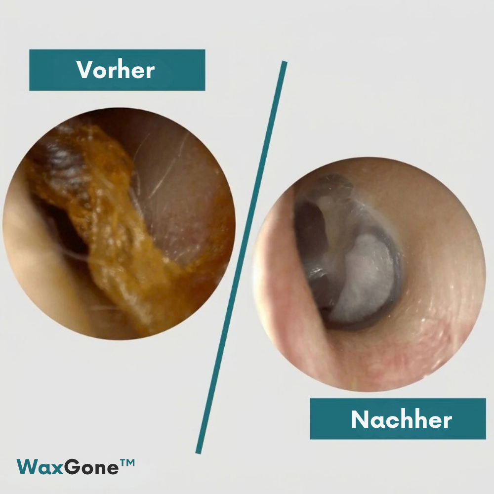WaxGone™ | Entfernen Sie Ohrenschmalz sanft und ohne Wattestäbchen