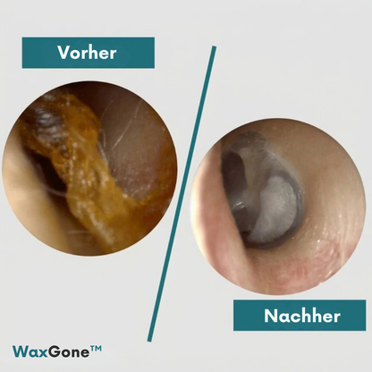WaxGone™ | Entfernen Sie Ohrenschmalz sanft und ohne Wattestäbchen
