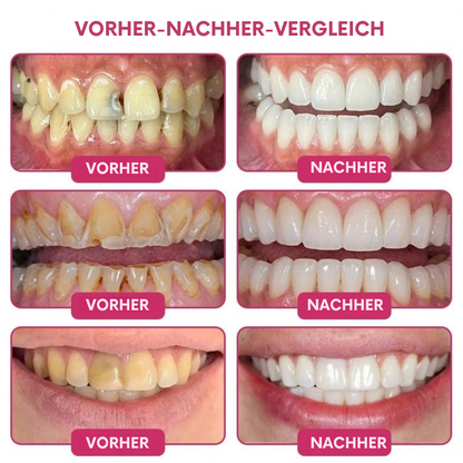 DenPerm™ | Gezielte Pflege für geschwächten Zahnschmelz