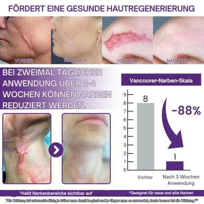 RegenScar™ | Für glattere und weniger auffällige Narben